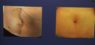 Surgery without (left) and with Dr. Greg Marchands Technique 